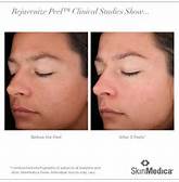 Vitalize Peel Before and After