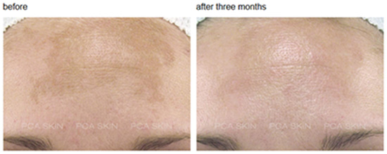 Vitalize Peel Before and After
