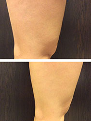 SculpSure laser fat removal at Radiance Fairfax before & after