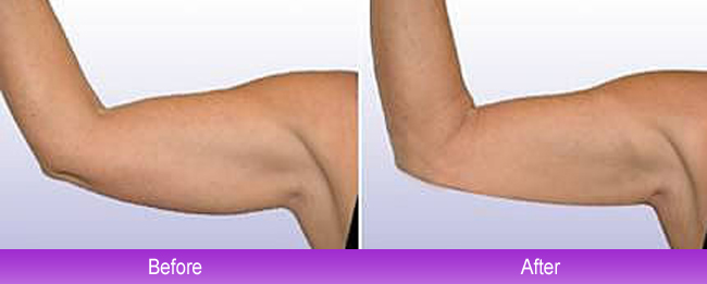 off Arm Liposuction, Affordable Arm Smartlipo Fairfax, VA
